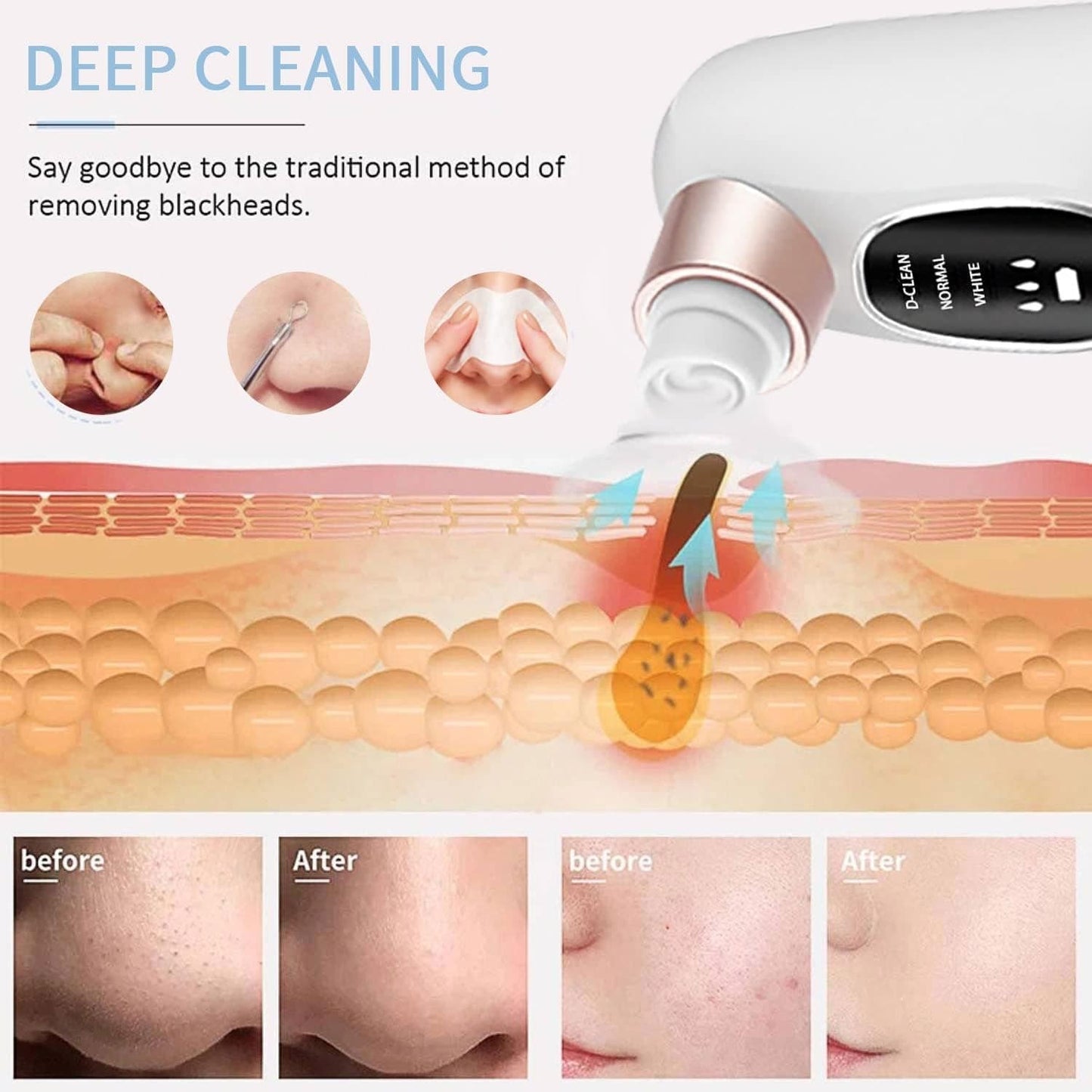 Electric Blackhead Remover – Vacuum Pore Cleanser