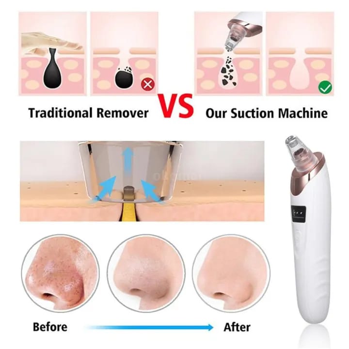 Rechargeable Blackhead Remover Vacuum – Pore Cleaner with LED & 4 Suction Heads